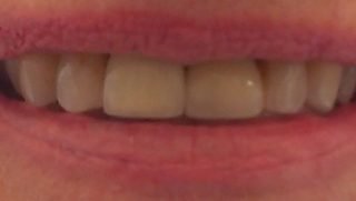 Alice - Dental Implants after