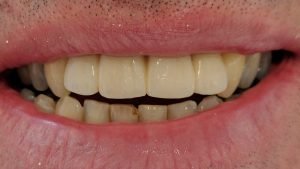 Neil - Dental Implants after