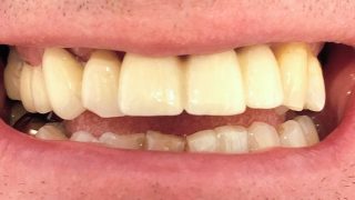Phil - Dental Implants after