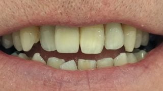 Matt - Dental Implants after