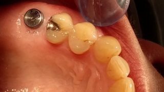 Irene - Dental Implants before