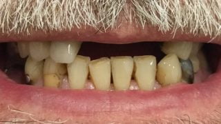 John - Dental Implants before